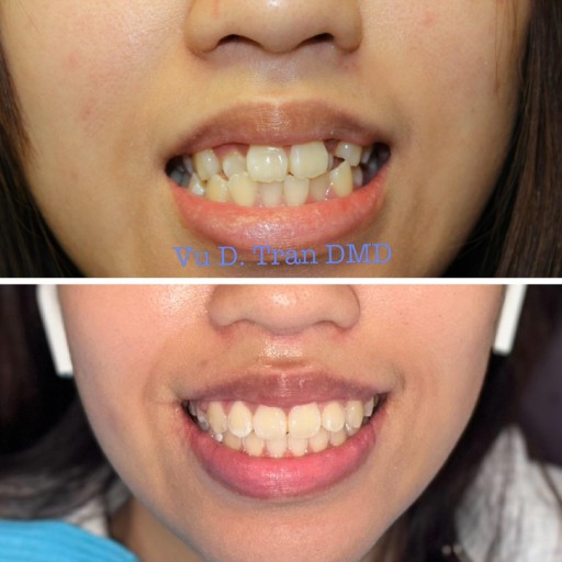 Smile makeover before and after, case one, at Annandale Dental Care