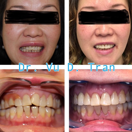 Smile makeover before and after, case two, at Annandale Dental Care