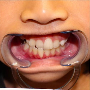 A patient's smile before dental treatment at Annandale Dental Care